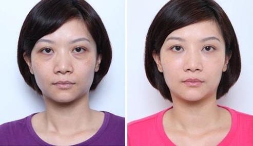 下眼袋松弛怎么办